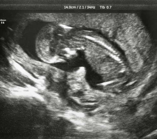 Fetal Ultrasound